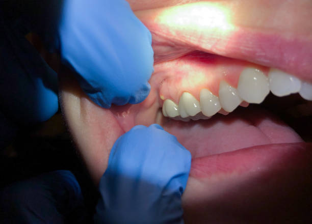 Best Emergency Tooth Extraction in Creola, AL