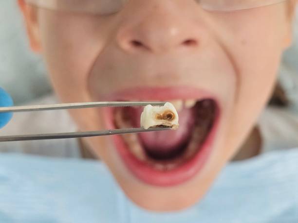 Best Emergency Dental Care for Broken or Chipped Teeth in Creola, AL